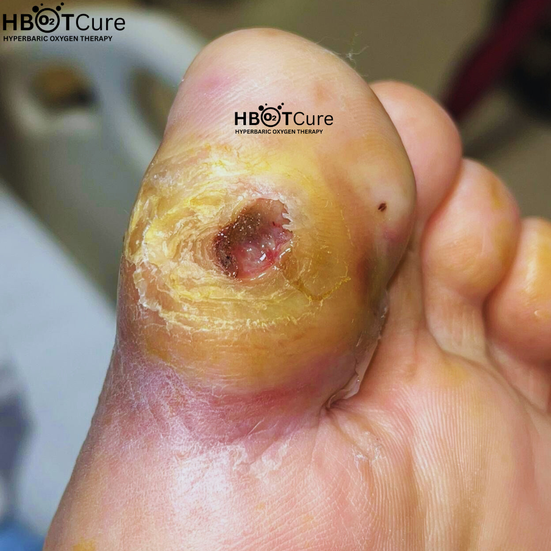 HBOT for Diabetic Foot